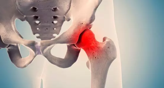 Avascular Necrosis Of Hip Treatment